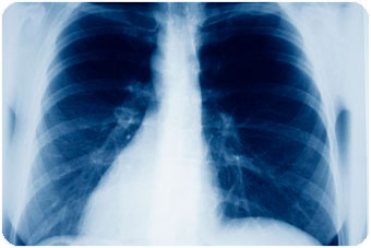 x-ray-lungs-chest.jpg